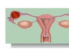 grossesse extra-utérine (GEU)