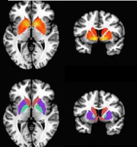 Syndrome de FATIGUE CHRONIQUE: Des indices visibles dans le cerveau – PLoS ONE
