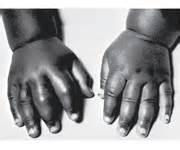 Doleur dans les mains