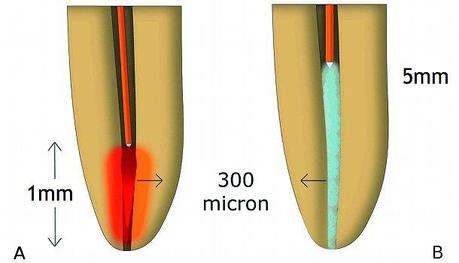 Le Laser en endodontie
