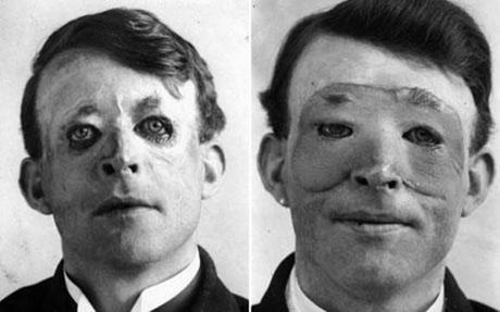 Walter Yeo, l’une des premières personnes à avoir subi une opération de chirurgie plastique et de transplantation de peau en 1917