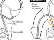 CONTRACEPTION MASCULINE: Vasalgel, pour vasectomie, mais provisoire Parsemus Foundation