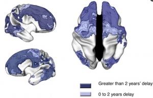 TDAH: Mieux comprendre et gérer ce déficit de l'attention avec hyperactivité  – NIH et PNAS