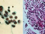 Utilisation radiothérapie thoracique pour traitement cancer poumon petites cellules étendu étude phase randomisée contrôlée