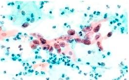 CANCER du COL: Dépister le HPV par simple test urinaire – BMJ