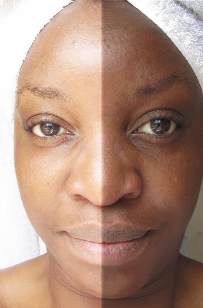 L'hyperpigmentation: le fléau des peaux noires - À Lire