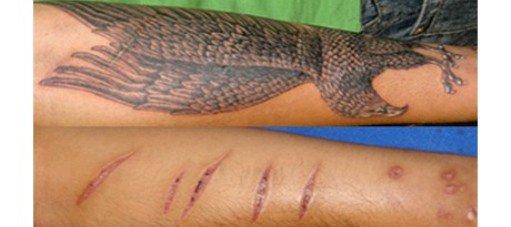 tattoo-camouflage-cicatrice-tatouage -scar-mogwaii (24)