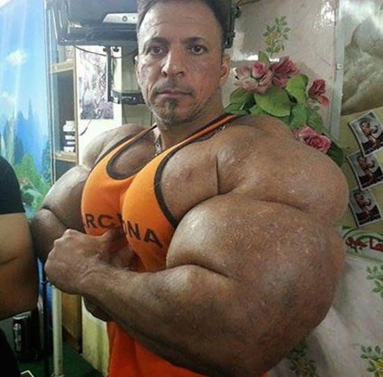 Synthol muscles horrible