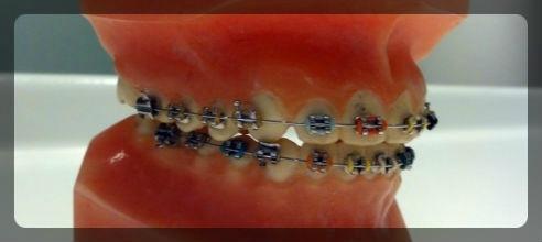orthodontie-Appareil-dentaire-adulte-30ansenbeaute-549x326