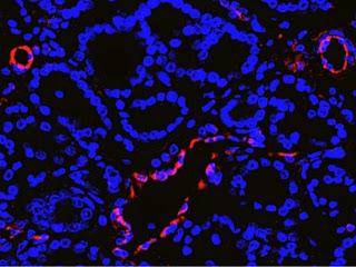 #EnUne #cancerdelaprostate #génomique #radiothérapie #imagerie #prostatectomie #prospectivethérapeutique Hétérogénéité tumorale génomique et microenvironnementale pour la prédiction intégrée à 5 ans de la récidive biochimique du cancer de la prostate :...