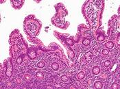 #lymphome #MALT #bendamustine #rituximab Modulation d’un traitement base bendamustine rituximab administré première intention selon réponse obtenue chez patients atteints lymphome tissu lymphoïde associé muqueuses (MALT2008-0...
