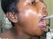 anguille vivante coince dans gorge d’un adolescent