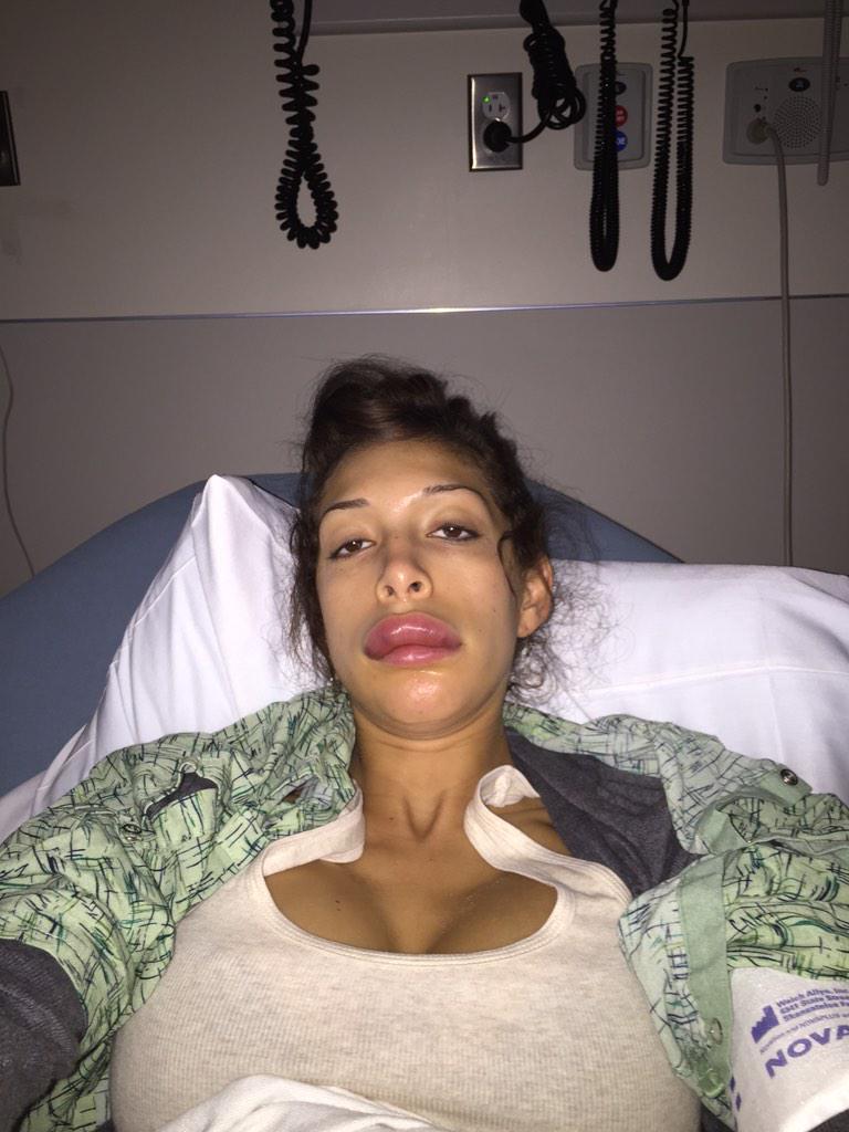 L'injection de botox qui tourne mal (Farrah Abraham)