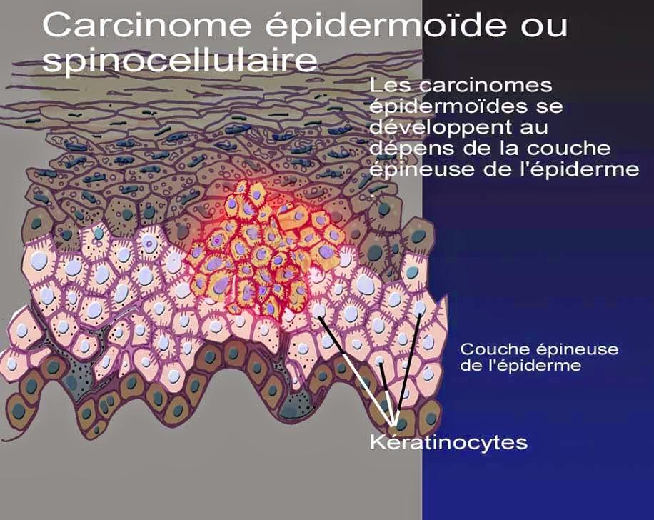 #thelancetoncology #carcinomeépidermoïde #EGFR #panitumumab #radiothérapie #cisplatine #radiochimiothérapie Panitumumab + radiothérapie versus radiochimiothérapie chez des patients atteints de carcinome épidermoïde localement avancé non réséqué de la t...