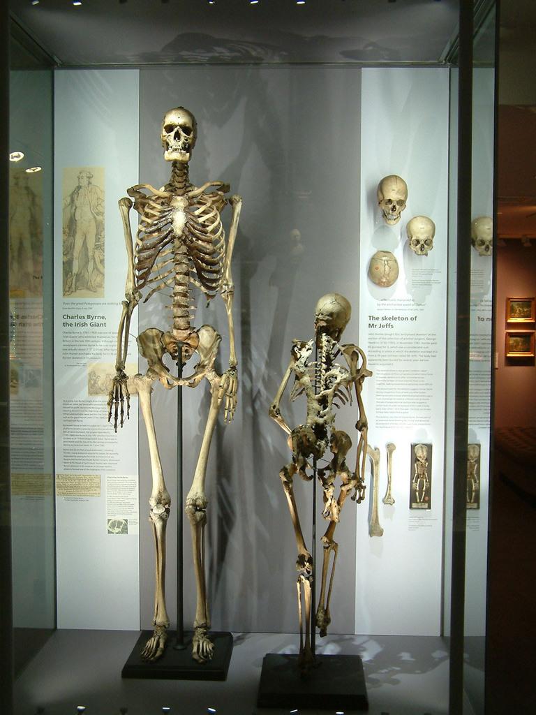 Le clou du Musée : The Irish Giant et son pote, l'homme qui se calcifiait.