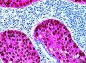 #thelancetoncology #CBNPC #cancer #nivolumab Activité innocuité nivolumab, inhibiteur point contrôle immunitaire PD-1, chez patients atteints cancer squameux poumon petites cellules réfractaire avancé (CheckMate 063) ét...