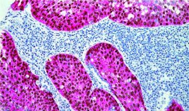 #thelancetoncology #CBNPC #cancer #nivolumab Activité et innocuité de nivolumab, inhibiteur du point de contrôle immunitaire PD-1, chez des patients atteints de cancer squameux du poumon non à petites cellules réfractaire et avancé (CheckMate 063) : ét...