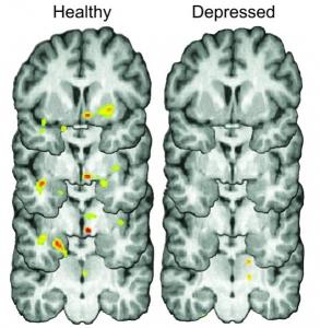 DÉPRESSION: Se secouer? Pas facile quand on est déprimé! – Molecular Psychiatry