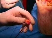 Technique réparation cartilage articulaire genou allogreffe