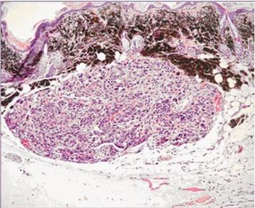 #thelancetoncology #mélanome #nivolumab #IgG4PD-1 #ipilimumab #inhibiteurdeBRAF #paclitaxel #dacarbazine #carboplatine Nivolumab versus chimiothérapie chez des patients atteints d’un mélanome avancé ayant progressé après un traitement anti-CTLA-4 (Chec...