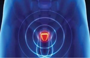 CANCER de la PROSTATE: La vitamine D réduit l'agressivité des tumeurs  – ACS