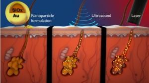 ACNÉ: Nanoparticules et ultrasons pour un traitement local et puissant – Journal of Controlled Release
