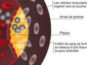 DÉMENCE: L'athérosclérose, facteur prédicteur risque Alzheimer's Dementia