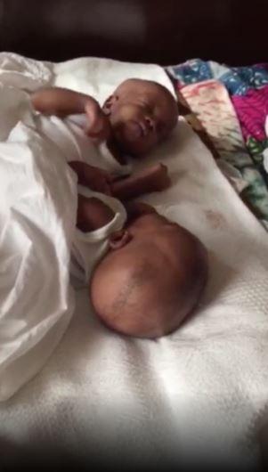 HUMANITAIRE : Aidez les bébés siamois de Guinée – La Chaîne de l’Espoir