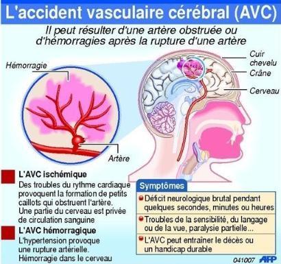representation accident vasculaire cérébral