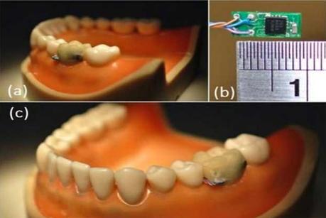 Vers des dents connectées? Nos dents intégreront la technologie Buetooth