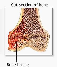 Un bon coup sur le fémur !