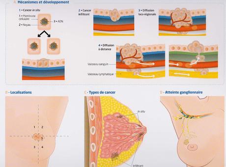 #thelancet #cancerdusein #denosumab #anti-aromatases Denosumab en adjuvant dans le cancer du sein (ABSG-18) : un essai multicentrique, randomisé, en double – aveugle et contrôlé par placebo