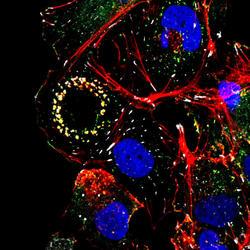 #thelancetoncology #microRNA #microARNsérique #carcinomehépatocellulaire Un classificateur de microARN sérique pour la détection du carcinome hépatocellulaire : une étude longitudinale, multicentrique et rétrospective d’identification de biomarqueur, a...