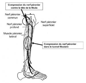 RHABDOMYOLYSE: Un jean trop slim peut vous couper les jambes! – Journal of Neurology, Neurosurgery and Psychiatry