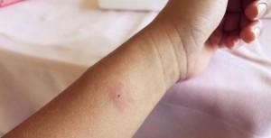 La chasse aux moustiques Les piqures de moustiques