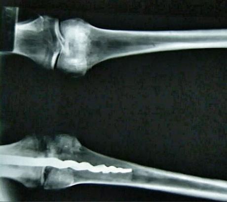 Le mystère d'une broche orthopédique au genou d'une momie égyptienne de  3000 ans - À Lire