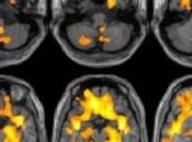 TOXICOMANIE: Elle réduit volume cerveau. Surtout chez femmes Radiology