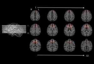 NEURO: Savoir attendre sa récompense dépend de la substance blanche – Proceedings of the Royal Society B: Biological Sciences