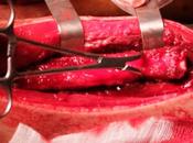Reconstruction l’ulna fibula vascularisée volumineux kyste osseux anevrismal diaphysaire
