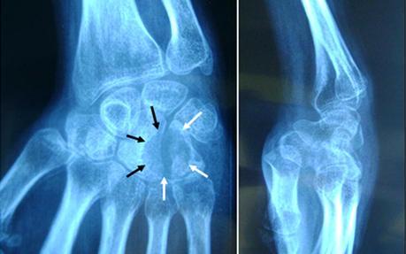L’hémangiome intra-osseux du carpe, une entité exceptionnelle scaph