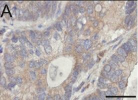 CANCER: Couper les vivres aux cellules tumorales via leurs capteurs alimentaires  – Oncogene