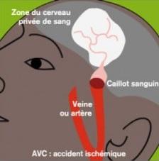 AVC: Découverte d'un biomarqueur du risque de complications hémorragiques  – Neurology