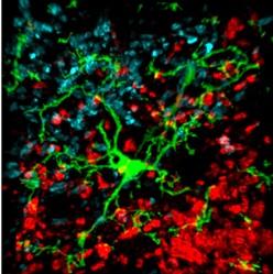SCHIZOPHRÉNIE: Des anti-inflammatoires pour la prévenir? – American Journal of Psychiatry