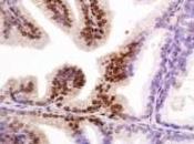 CANCER Prostate: test sanguin pour prédire réponse traitement Science Translational Medicine