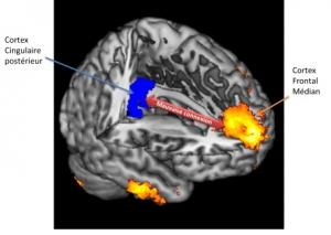 COMA: Quand 2 zones du cerveau déconnectent – Inserm et Neurology