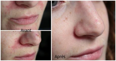 Ma Jolie Peau grâce à OMUM ❤❤❤