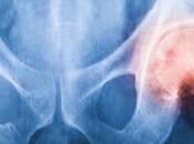 Arthrose terminez chaise roulante