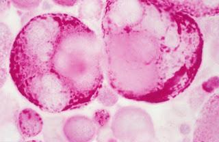 #thelancetoncology #cancerdel’ovaire #angiogénèse #carboplatine #paclitaxel #nintedanib Chimiothérapie standard de première intention avec ou sans nintedanib pour le cancer de l’ovaire avancé (AGO-OVAR 12) : un essai de phase 3 randomisé, en double-ave...