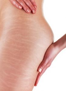 VERGETURES: Pourquoi il vaut mieux prévenir que guérir – British Journal of Dermatology