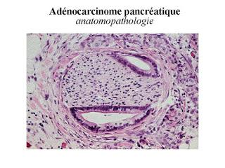 #thelancet #cancerdupancreas #irinotecan #fluorouracile #acidefolinique #gemcitabine Irinotecan en nanoliposome avec fluorouracile et acide folinique dans le cancer du pancréas métastatique après précédent traitement à base de gemcitabine (NAPOLI-1) : ...